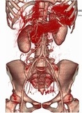 腹部大動脈３Ｄ画像